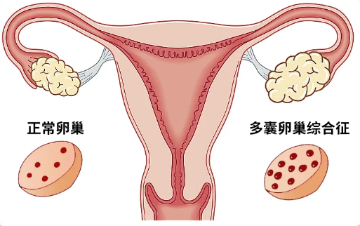 多囊卵巢.png